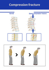 압박골절 설명을 위한 메디컬일러스트