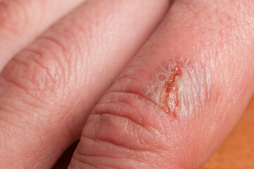 Detail of infected burn on a woman's finger