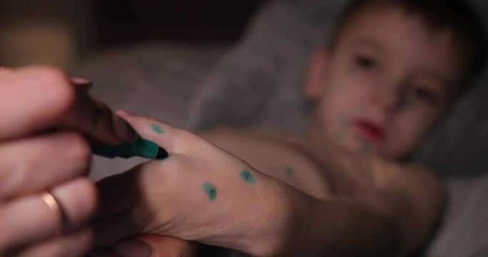 woman on the child's hand puts a dot marker green. baby sick with chickenpox lying on the bed. cure for chickenpox. the acne of chicken pox is clearly visible.
