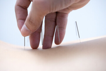 close up of hand acupuncture treatment