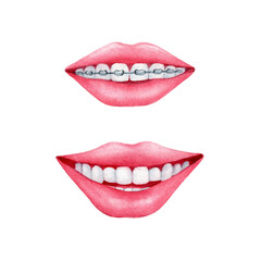 Watercolor hand drawn smile with perfect teeth and smile with 
braces. Red lips and white teeth on white background isolated.