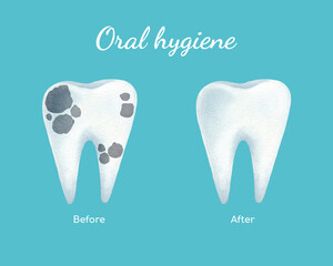 Watercolor poster design concept about oral hygiene. One bad tooth before dental treatment and cleaning and one healthy white tooth after treatment and cleaning. Good dental poster on blue background.