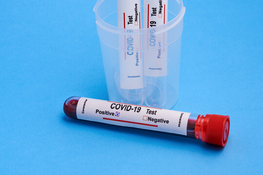 From above closeup of test tubes with blood samples in plastic cup for coronavirus diagnostic test with positive mark placed on blue background