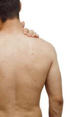 Man with skin problem on back.