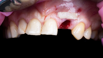 Fototapeta premium adding soft tissue to the mucous gums to increase volume and aesthetics after implantation