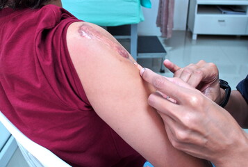 Injecting treatment for keloids on the shoulder
