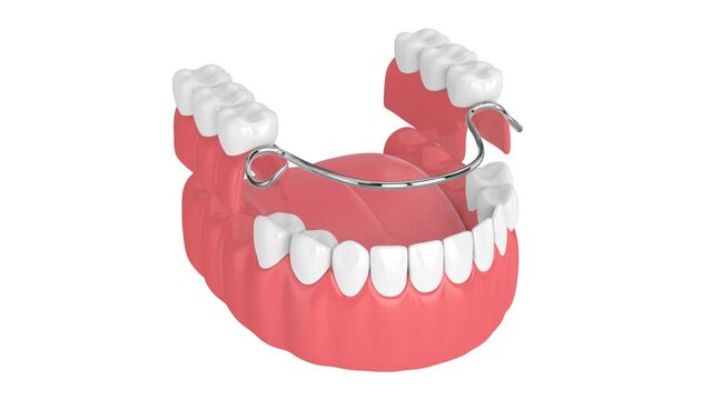 Removable partial denture isolated over white background