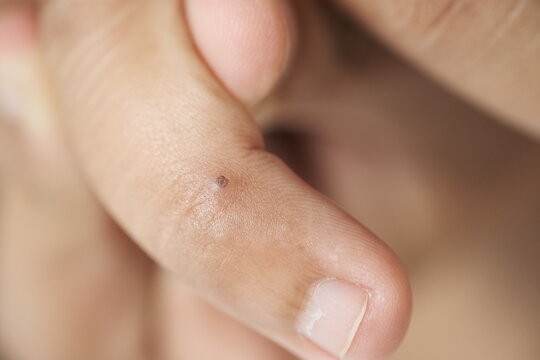 Warts that grow on the fingers