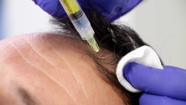 Hair mesotherapy or hair transplant. Beautician doctor makes injections in the man&rsquo;s head for hair growth or to prevent baldness. Trichology - treatment of baldness. 