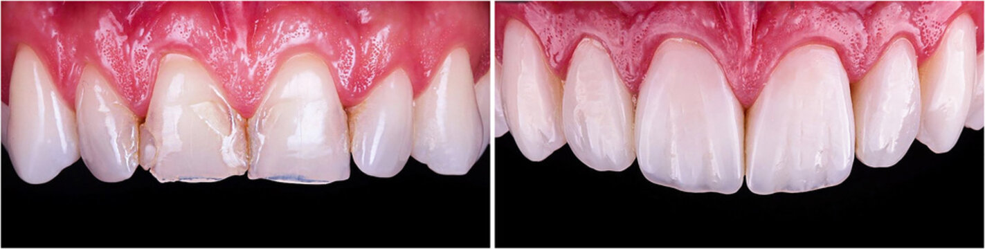 direct restoration of frontal teeth