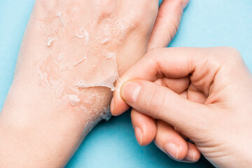 cropped view of woman peeling off exfoliated, dry skin from hand on blue