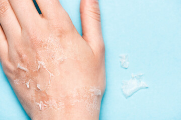 cropped view of female hand with dead, exfoliated skin on blue