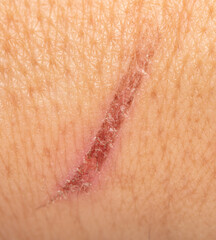A wound on the skin of a person.