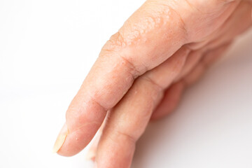 Close up Atopic dermatitis on finger(AD), also known as Atopic eczema.Skin disease concept.
