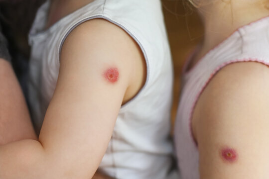 Kids with a reaction to the BCG vaccine on the forearm