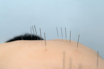 Acupuncture treatment in therapy room at Chinese mediciine clinic. Man cure his neck and shoulder by Chinese acupuncture treatment.