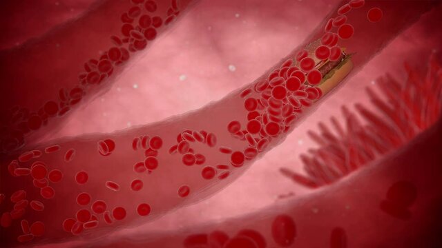 Clogged Artery with platelets and cholesterol plaque, concept for health risk for obesity or dieting and nutrition problems