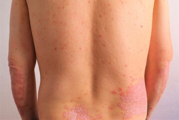 psoriasis, chronic non-infectious skin disease, autoimmune disease, red spots on the body