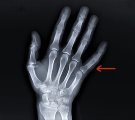 radiography of the hand bones with a fracture of the proximal phalanx of the fifth finger