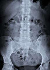 radiography of the lumbar spine in direct projection