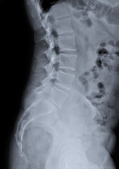 x-ray of the lumbar spine of an adult in a lateral projection