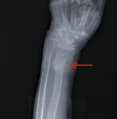 radius fracture on the x-ray of the forearm