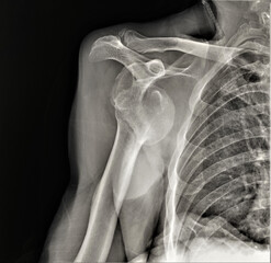 the x ray shows a dislocation of the humerus head