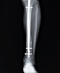 radiography with an unconsolidated fracture of the tibia of the fixed iron core
