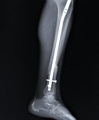 radiography with an unconsolidated fracture of the tibia of the fixed iron core