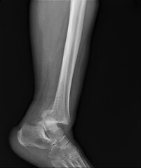 x-ray of an ankle fracture with a dislocated foot