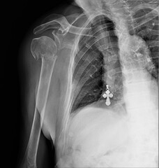 radiography of the shoulder joint with a fracture of the surgical neck of the humerus with...