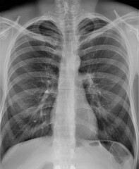 radiography of the chest.diagnosis of lung diseases.pneumonia