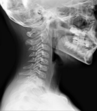 radiography of the cervical spine in a lateral projection