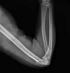 x-ray of the normal elbow joint.medical diagnostics