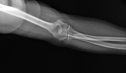 x-ray of the normal elbow joint.medical diagnostics