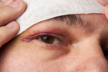close view of a black eye, man's face with a hematoma