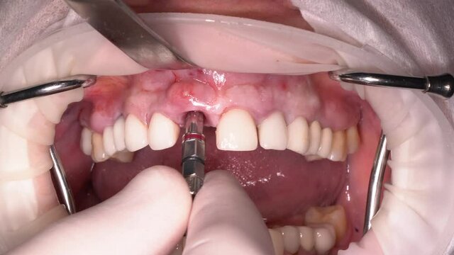 surgeon removes the dental implant with special equipment due to complications of inflammation in the gum cavity