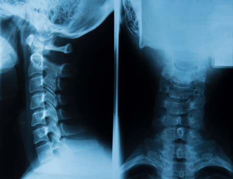 X-ray image of the cervical spine of a woman with osteochondrosis and displacement of the vertebrae.