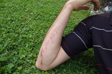 male person with a underarm abrasion after outdoor sports