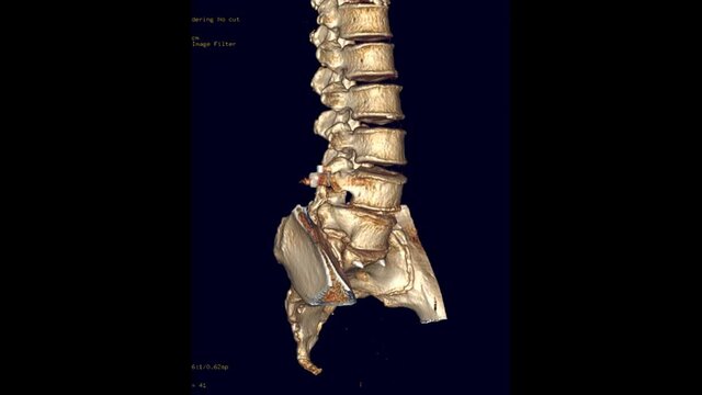 CT Lumbar spine or L-S spine 3D rendering image turn around on the screen  with  Pedicle screw fixation . 3D illustration.