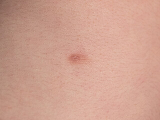 Fototapeta premium Picture of a male torso with a third nipple - Close-up (supernumerary nipple)