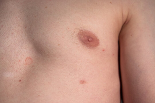 Picture of a male torso with a third nipple (supernumerary nipple)