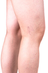 Varicose veins on the side of the knee joint.