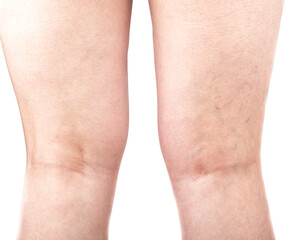 Female legs with varicose veins on the back of the legs.