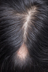 Alopecia Areata - Spot Baldness is a condition in which hair is lost from some or all areas of the body.