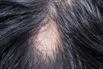 Alopecia Areata - Spot Baldness is a condition in which hair is lost from some or all areas of the...