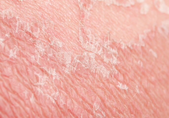 texture of irritated pigmented skin covered with cracks and scales after sunburn