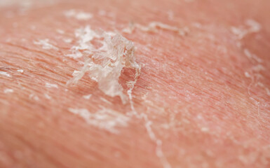 texture of irritated  skin with scales of dead cells and redness after sunburn and allergies leave the body