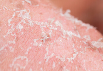 textured background with scales of dead skin cells covered with cracks after sunburn break off from the body