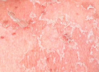 texture of irritated reddened skin with flaking scales of dead old cells after sunburn and allergies on the human body